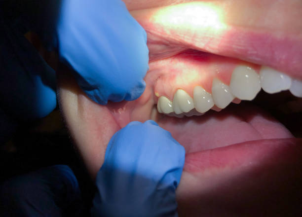 Best Emergency Dentist for Knocked-Out Tooth in Lake Dallas, TX